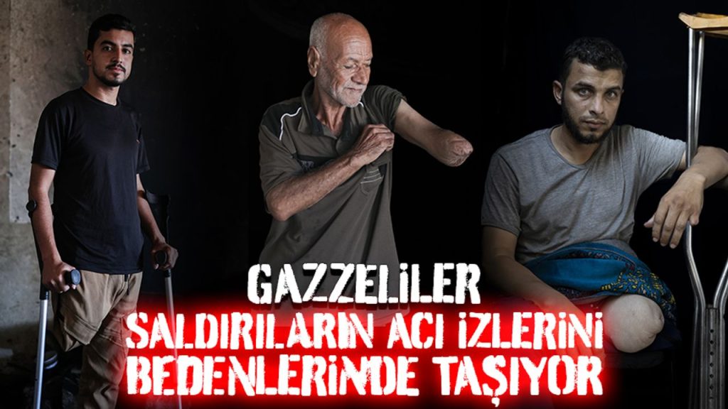 Gazze’deki siviller, işgalci saldırılarının acı izlerini bedenlerinde taşıyor